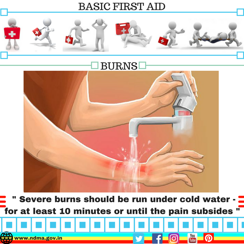 Severe burns should be run under cold water for at least 10 minutes or until the pain subsides